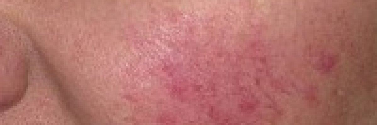 Létezik tartós megoldás is a rosacea-ra - Trombózisközpont