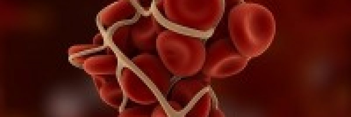 Vérzést és vérrögöket is okozhat az esszenciális trombocitémia