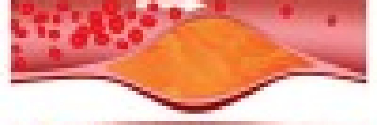 Vénás trombózis? Artériás trombózis? Mi a különbség?!