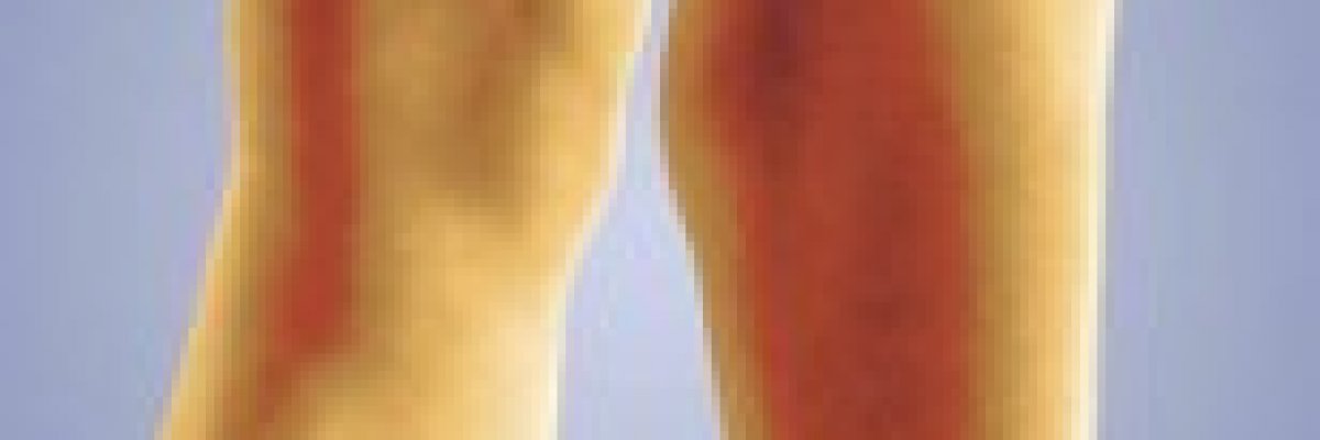 A kanyargós visszerek vénás trombózishoz vezethetnek