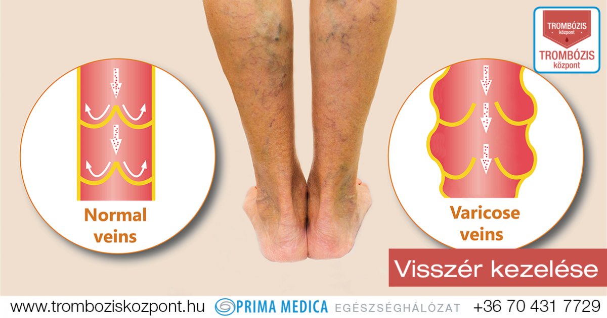 Visszérgyulladás trombózissal (thrombophlebitis)