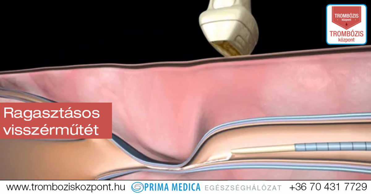 trombotikus visszér schistosoma mansoni visszér