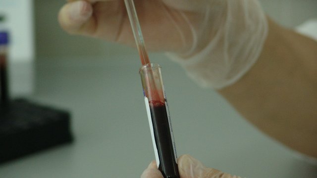 Esszenciális trombocitémia- sokáig tünetmentes, ám életveszélyes