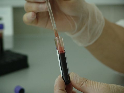 Esszenciális trombocitémia- sokáig tünetmentes, ám életveszélyes