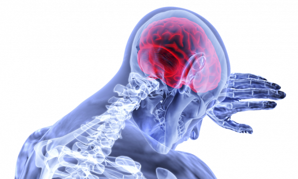 Trombotikus stroke- vérrög az agyban