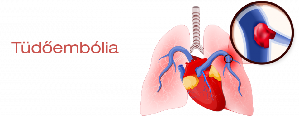 fogyás tüdőembólia