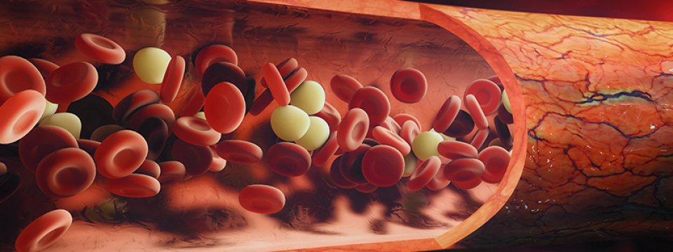 Aplasztikus vérszegénység - Cord Blood Center Group