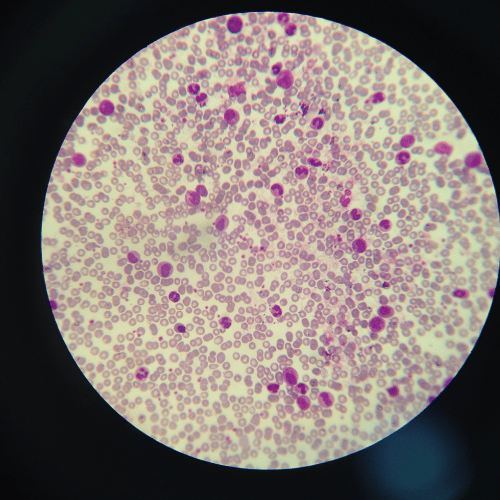 A krónikus limfoid leukémia nem jelent halálos ítéletet - Trombózis- és Hematológiai Központ