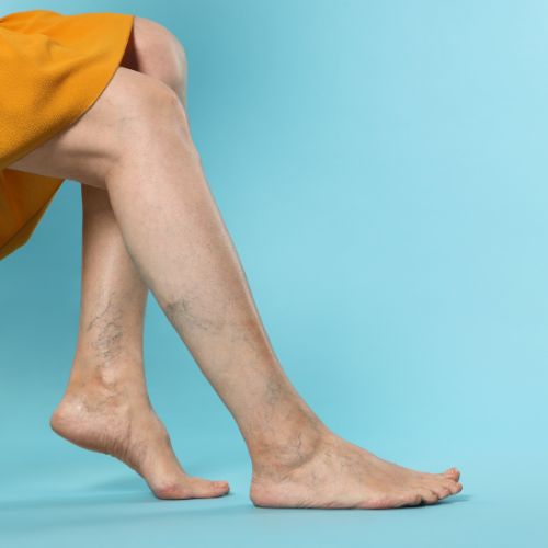 Néma trombózis-tünetei nincsenek, ám halállal végződhet - Trombózis-, és Hematológiai Központ