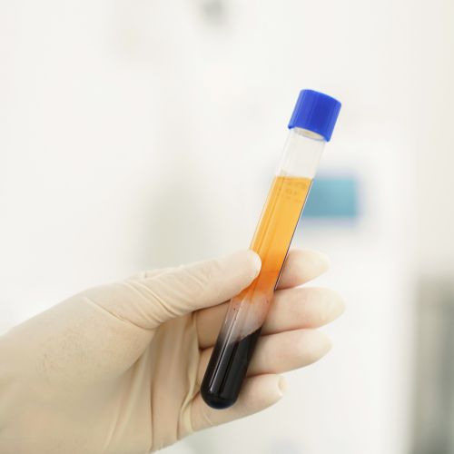 Tűszúrásszerű piros pöttyök a bőrön- ezt jelezheti - Trombózis- és Hematológiai Központ