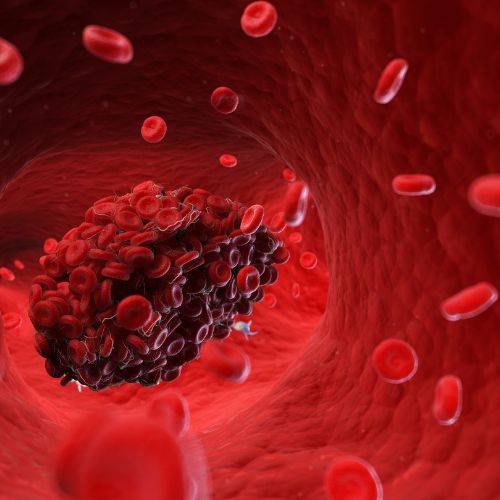 Vetélés után érdemes antifoszfolipid szindrómára is gyanakodni - Trombózis-, és Hematológiai Központ